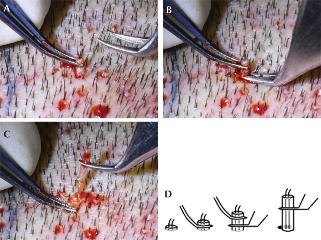 Close-up of FUE hair transplant procedure showing follicle extraction technique